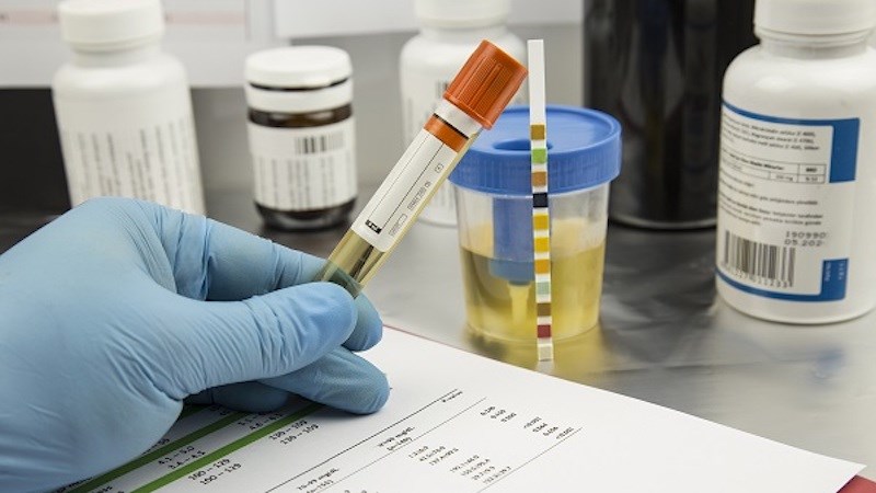 Xét nghiệm các chỉ số nước tiểu để chẩn đoán bệnh nuoc-tieu-duc-la-benh-gi-nguyen-nhan-va-dau-hieu-13