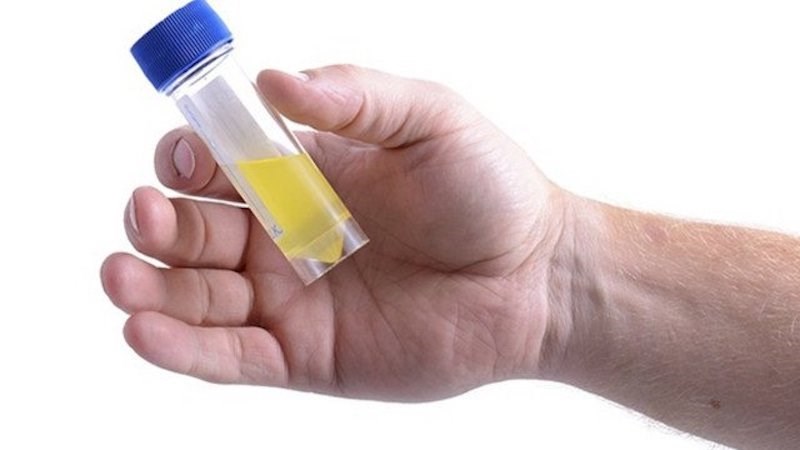 Biểu hiện của nước tiểu đục nuoc-tieu-duc-la-benh-gi-nguyen-nhan-va-dau-hieu-4