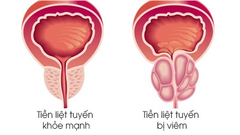 Nước tiểu đục là biểu hiện của viêm tiền liệt tuyến nuoc-tieu-duc-la-benh-gi-nguyen-nhan-va-dau-hieu-8