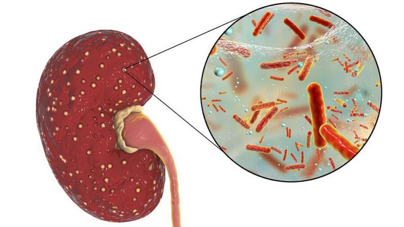 Nước tiểu đục là biểu hiện của nhiễm trùng thận nuoc-tieu-duc-la-benh-gi-nguyen-nhan-va-dau-hieu-9