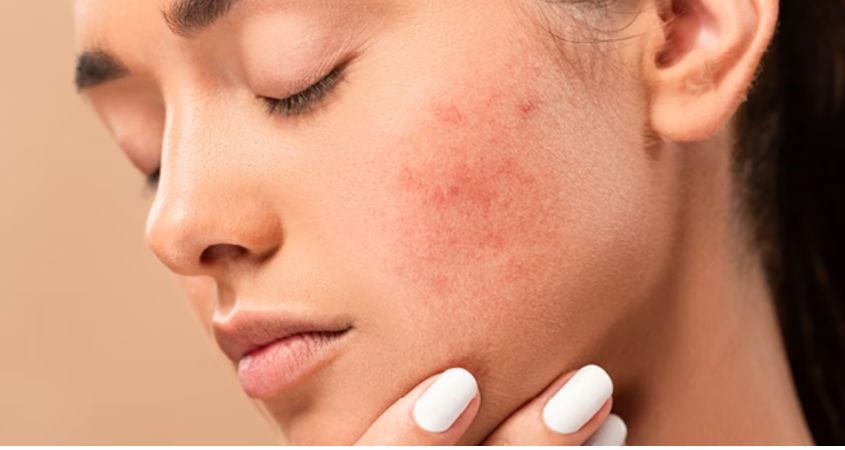 Cần sử dụng retinol phù hợp để tránh tình trạng kích ứng trên da Cần sử dụng retinol phù hợp để tránh tình trạng kích ứng trên da