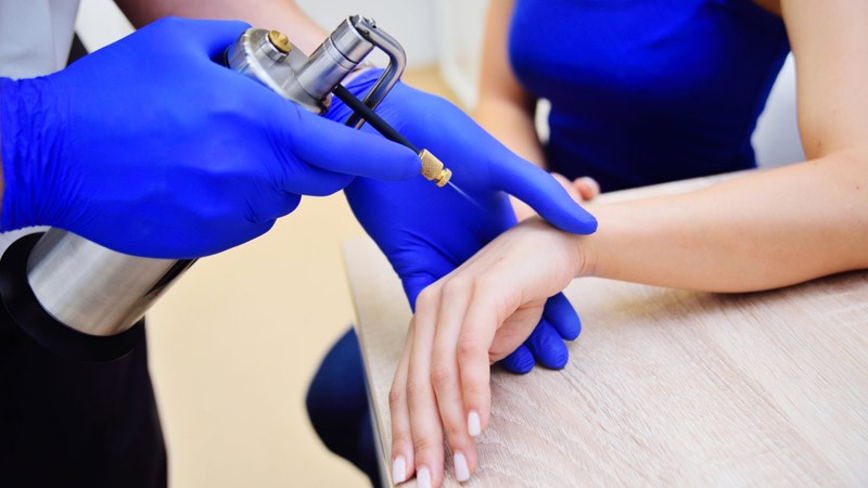 Phẫu thuật lạnh làm tế bào ung thư đóng băng và tróc ra