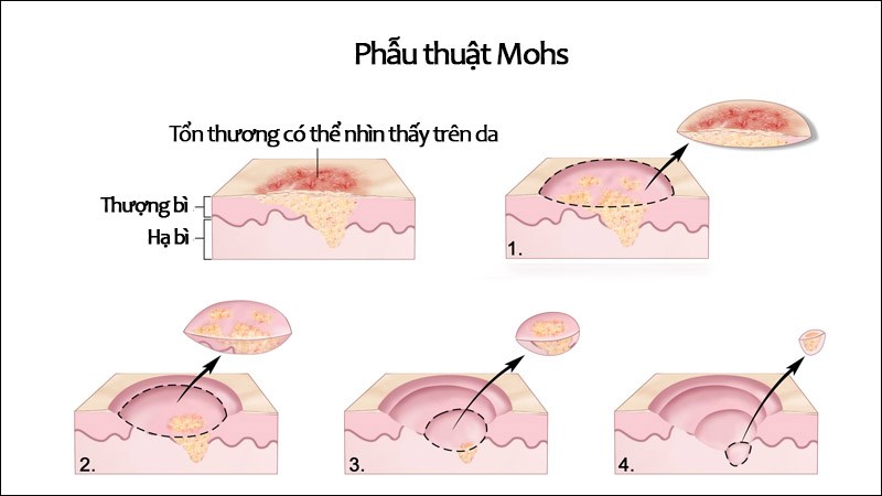 Phẫu thuật Mohs loại bỏ từng lớp da mỏng ở vị trí khối u