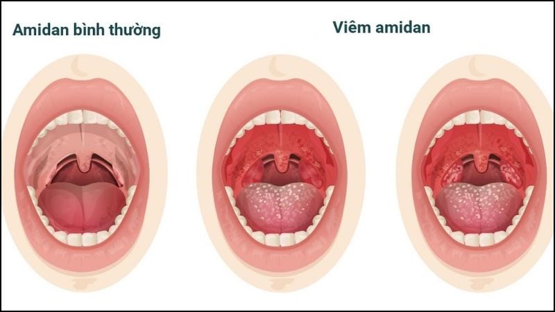 Phân biệt viêm họng và ung thư vòm họng qua 6 điều sau