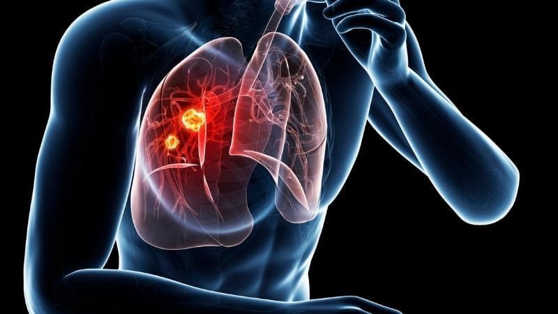 Ung thư vòm họng là bệnh lý ác tính và có thể di căn đến các cơ quan khác như phổi