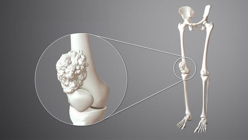 Ung thư xương là sự gia tăng bất thường các tế bào xương