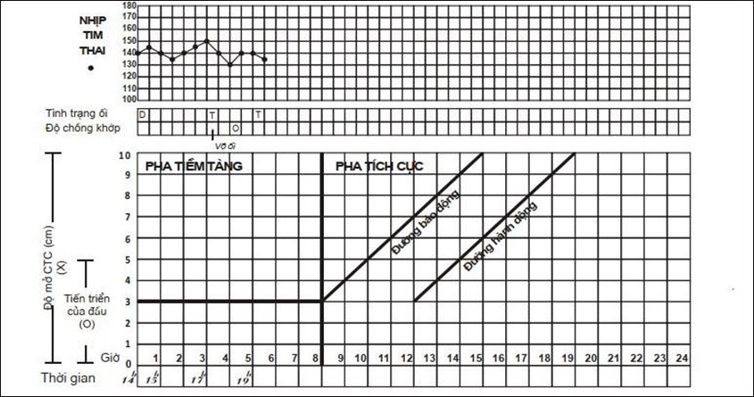 Biểu đồ chuyển dạ là gì
