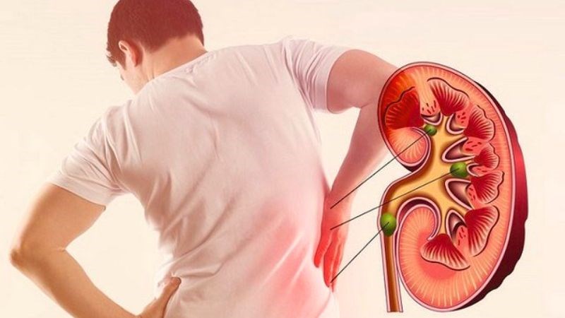 Ăn nhiều cà chua có thể dẫn đến việc bị sỏi thận