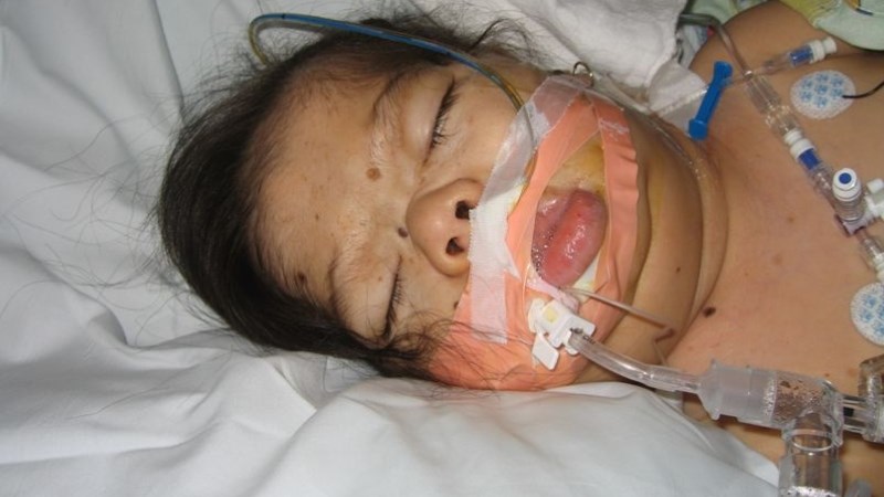 Bệnh Myxedema