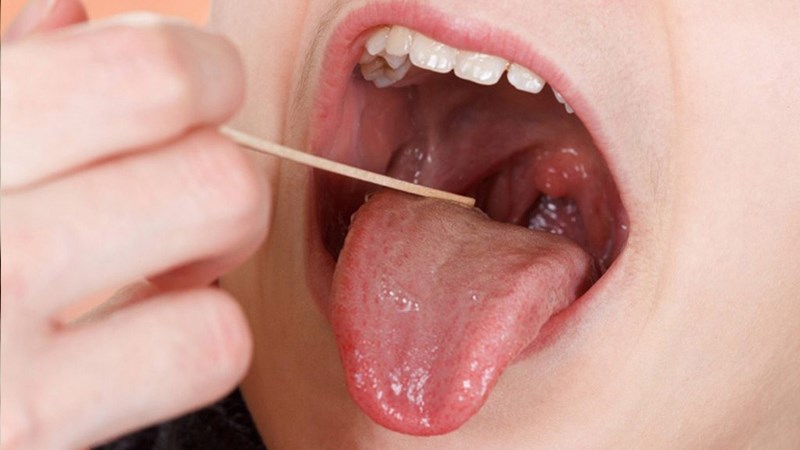 Hình ảnh bác sĩ khám lâm sàng trong chẩn đoán bệnh viêm họng
