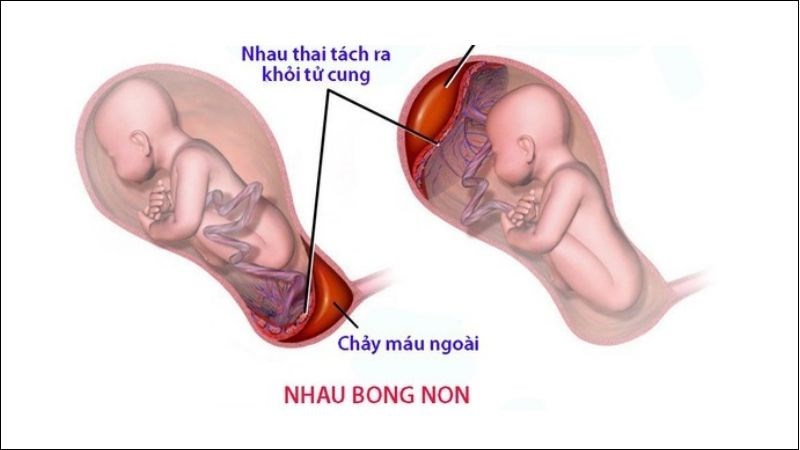 Nhau bong non gây chảy máu thai kỳ