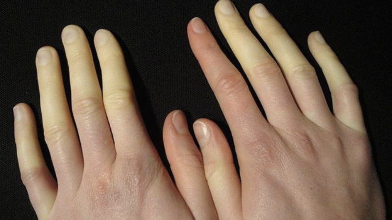 Bệnh raynaud làm co thắt mạch máu gây tê đầu ngón tay