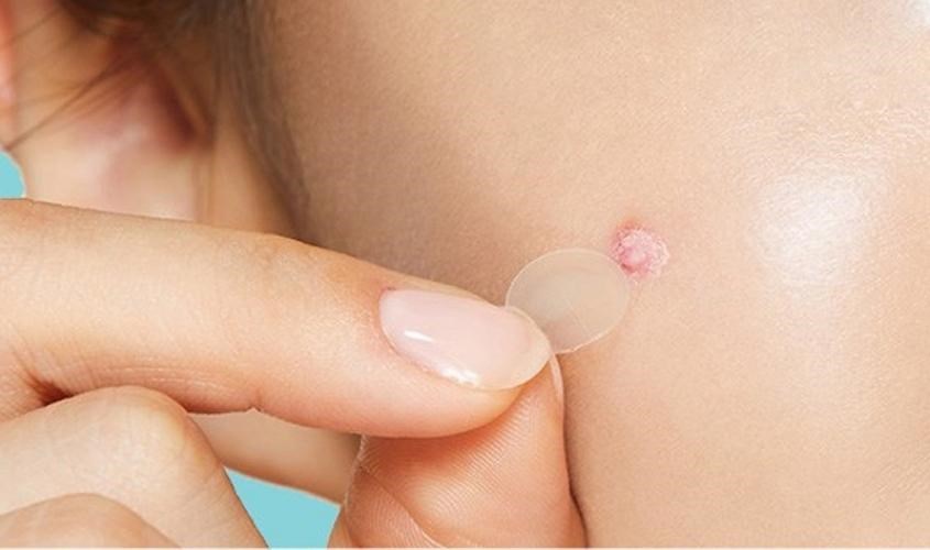 Miếng dán mụn giúp vùng mụn của bạn sẽ được phục hồi nhanh chóng