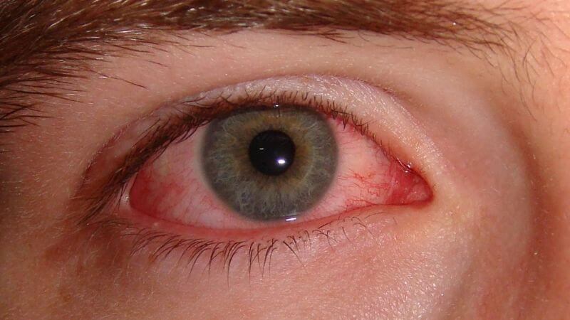 Lá sen giúp giảm đau ở người đau mắt, đỏ mắt