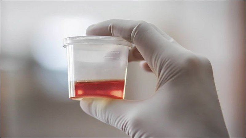 Có máu trong nước tiểu do rối loạn chức năng lọc của thận