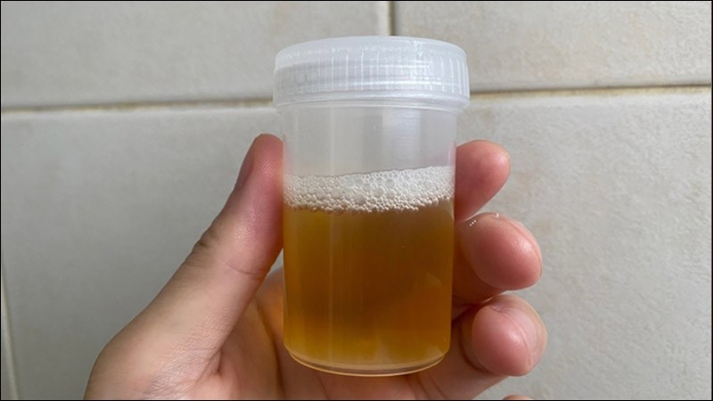 Rò rỉ albumin làm xuất hiện bọt trong nước tiểu