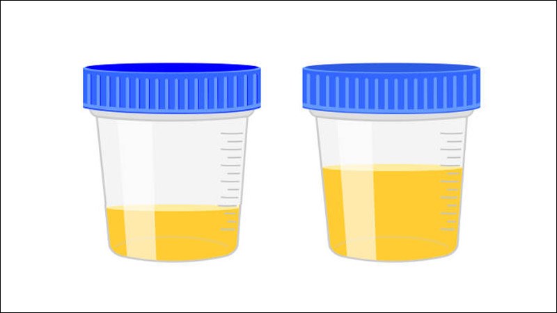 Giảm lượng nước tiểu có thể là dấu hiệu chức năng thận suy giảm