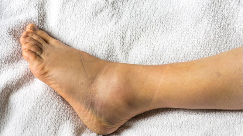 Sưng phù bàn chân do natri trong máu tăng