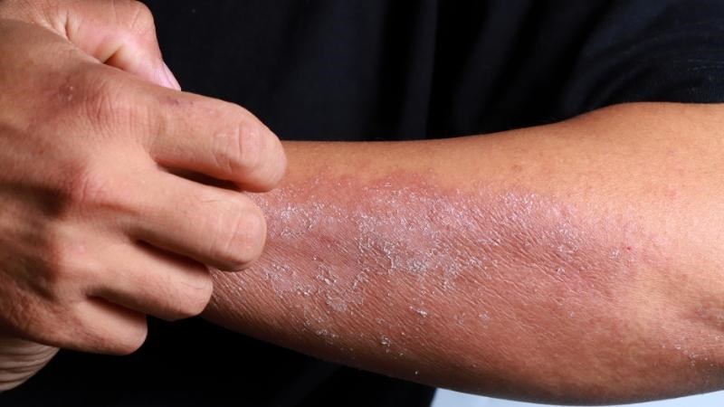 Da khô và ngứa trong bệnh thận do tích tự phốt pho dưới da