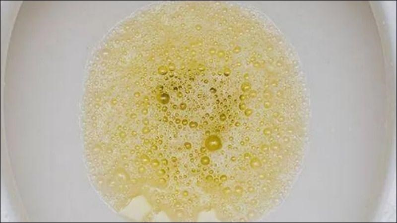 Bọt trong nước tiểu nhiều và lâu tan là dấu hiệu của sự có mặt protein trong nước tiểu