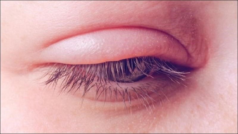 Phù mi mắt trong bệnh thận thường xuất hiện vào buổi sáng