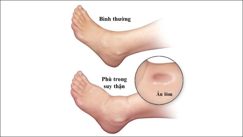 Bạn có thể kiểm tra dấu hiệu phù bàn chân bằng cách ấn lõm vào mu bàn chân