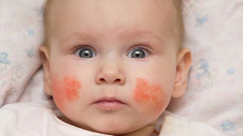 Cỏ mực chữa bệnh chàm ở trẻ em 