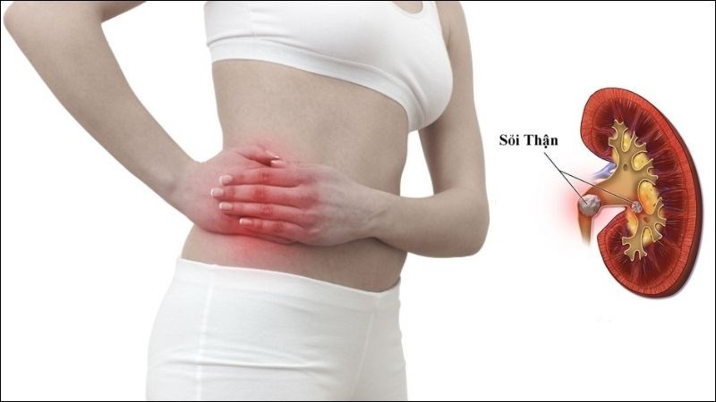 Cỏ mực hỗ trợ điều trị sỏi thận 