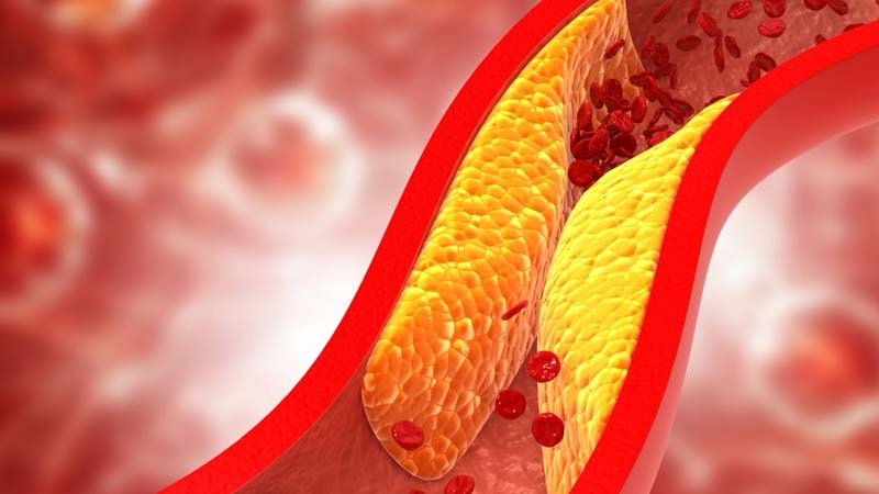 Xơ vữa mạch máu làm tăng nguy cơ biến chứng tim mạch.