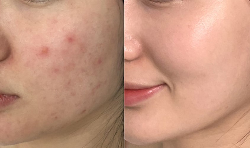 Toner giúp cải thiện tình trạng mụn trong vòng 30 ngày sử dụng