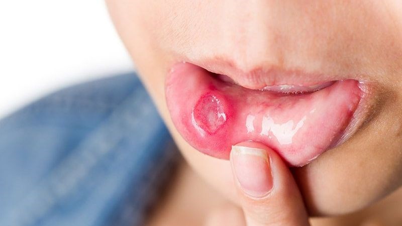 Bị viêm loét miệng không nên ăn ớt 