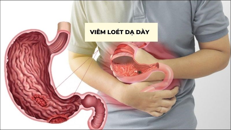 Viêm, loét dạ dày không nên ăn ớt do ảnh hưởng sự phục hồi tiêu hóa
