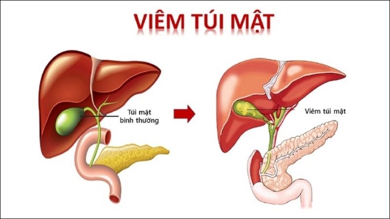 Người bị viêm túi mật không nên ăn ớt