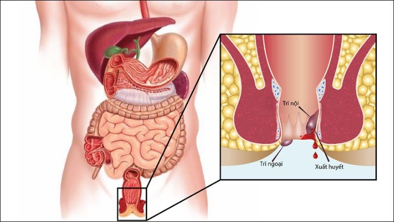 Người bị trĩ nên hạn chế việc ăn cay, ăn ớt