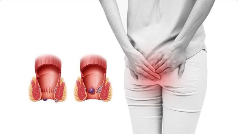 Ăn ớt có nguy cơ bị trĩ 