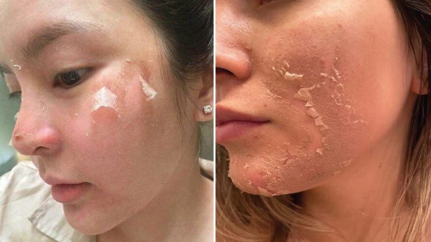 Da sau peel sẽ bong tróc lớp da cũ