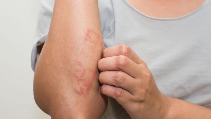 Vitamin E giúp giảm bớt các triệu chứng khó chịu của bệnh chàm