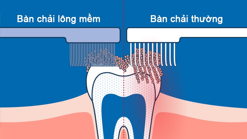 Bàn chải lông mềm giúp vệ sinh răng miệng hiệu quả và an toàn hơn