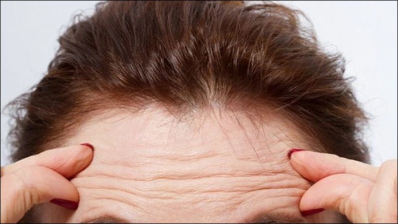 Trán mất khả năng đàn hồi là dấu hiệu xuất hiện vết nhăn trên trán