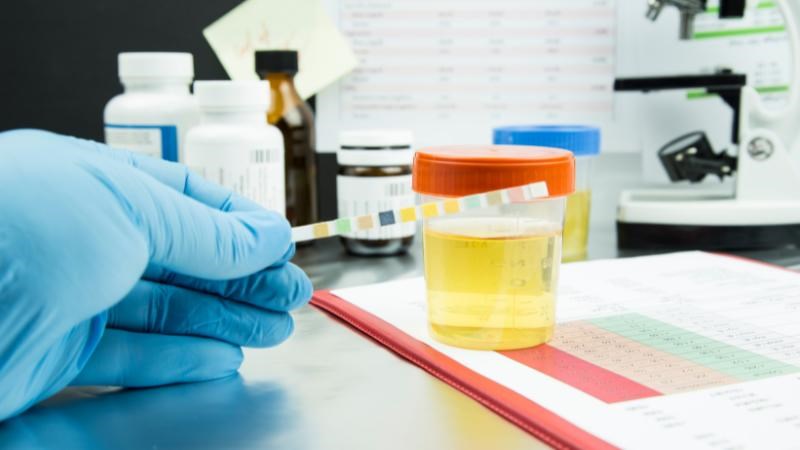 Xét nghiệm nước tiểu được dùng trong chẩn đoán Xét nghiệm nước tiểu được dùng trong chẩn đoán