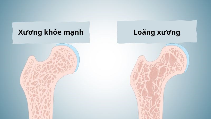 Hạt diêm mạch giúp ngăn ngừa loãng xương