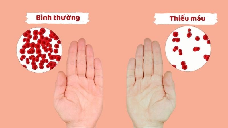 Hạt diêm mạch giúp điều trị bệnh thiếu máu