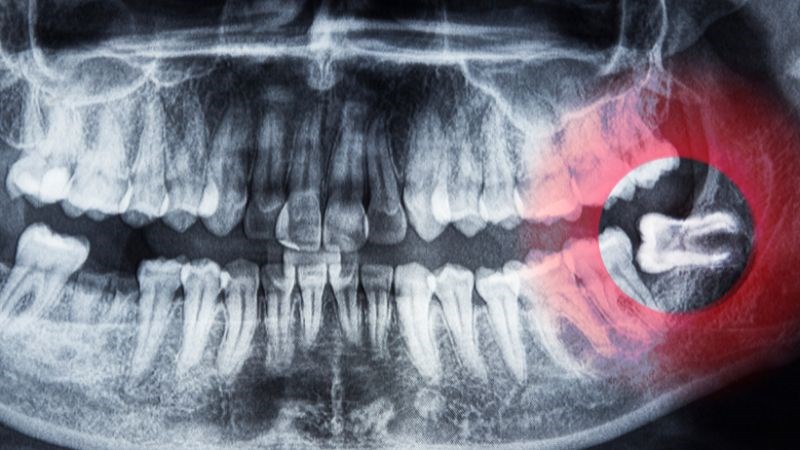 Răng khôn mọc lệch có thể gây ra nhiều vấn đề