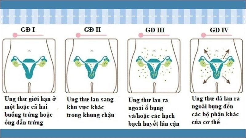 Ung thư buồng trứng được phân thành 4 giai đoạn bệnh
