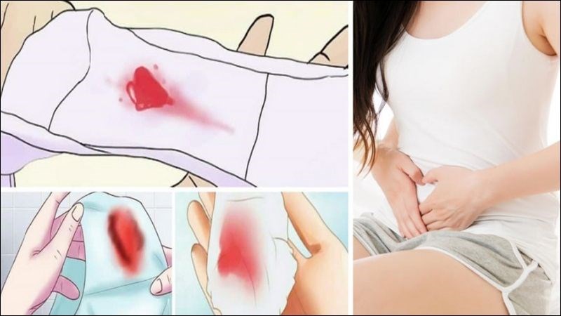 Ra máu âm đạo bất thường có thể là dấu hiệu cảnh báo ung thư buồng trứng