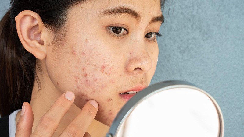 Da thay đổi, nổi mụn nhiều có thể do sự rối loạn nội tiết tố Da thay đổi, nổi mụn nhiều có thể do sự rối loạn nội tiết tố