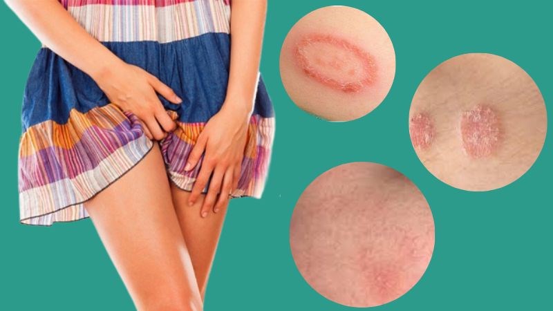 Các bệnh ngoài da có thể khiến vùng kín ngứa và đỏ rát