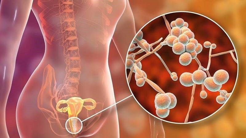 Viêm âm đạo do vi khuẩn là nguyên nhân phổ biến nhất của viêm âm đạo