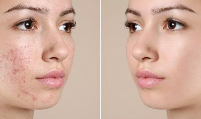 Mặt nạ collagen còn hỗ trợ điều trị mụn