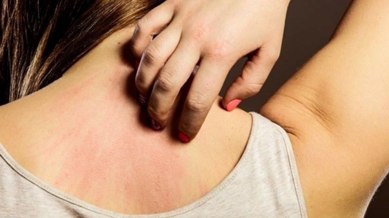 Tắm nước nóng có thể gây ngứa da